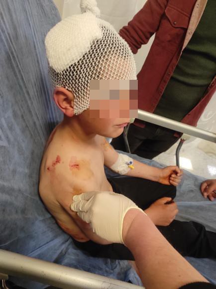 Isparta’nın Gönen ilçesinde sokakta oynarken başıboş köpeğin saldırısına uğrayan 9