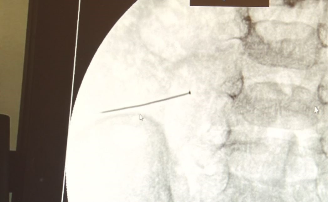 İstanbul'da 2 yaşındaki bir çocuk, yaklaşık 3 santimlik toplu iğne